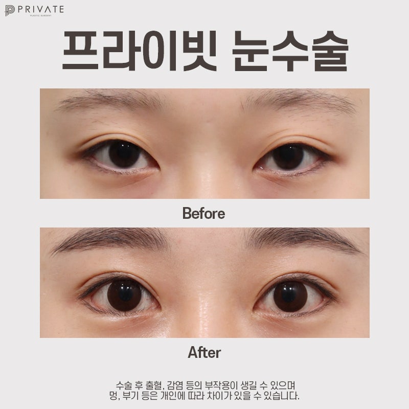 รีวิวศัลยกรรมตาสองชั้นแบบธรรมชาติที่ Private Plastic Surgery 사진 8