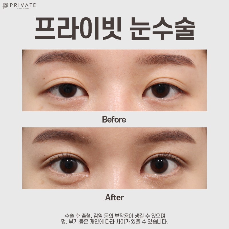 รีวิวศัลยกรรมตาสองชั้นแบบธรรมชาติที่ Private Plastic Surgery 사진 9