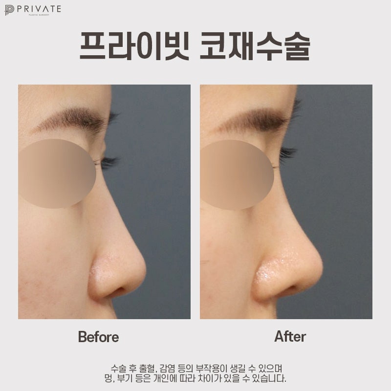 รีวิวศัลยกรรมจมูกแก้ไขดีเยี่ยมที่ Private Plastic Surgery Clinic 사진 9