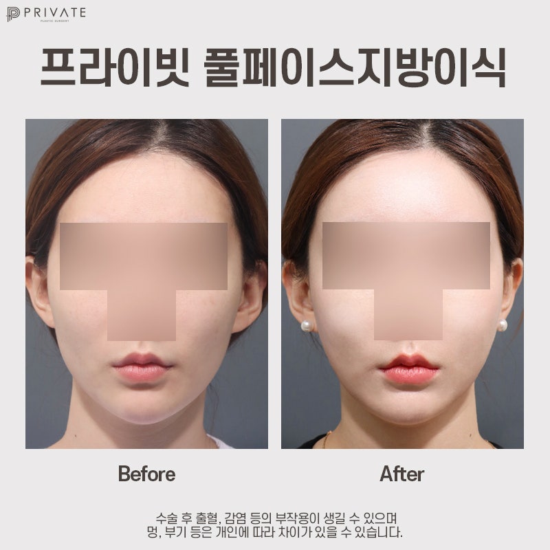 PRP Fat Grafting Effects: Learn More at Private Plastic Surgery 사진 10