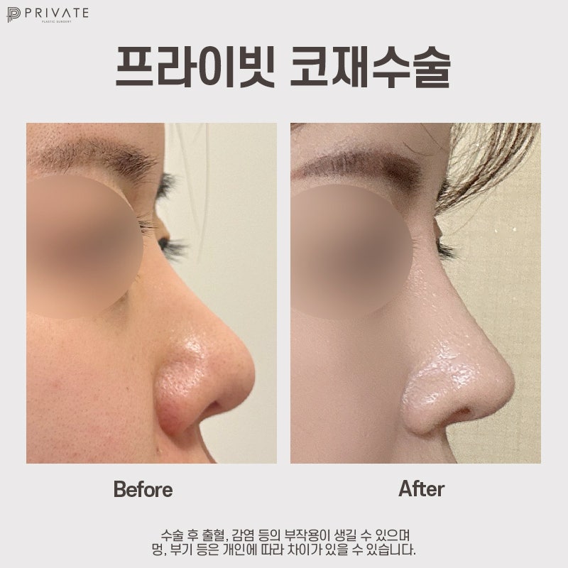 สถานที่ที่ทำศัลยกรรมจมูกแก้ไขได้ดีคือ Private Plastic Surgery Clinic 사진 11