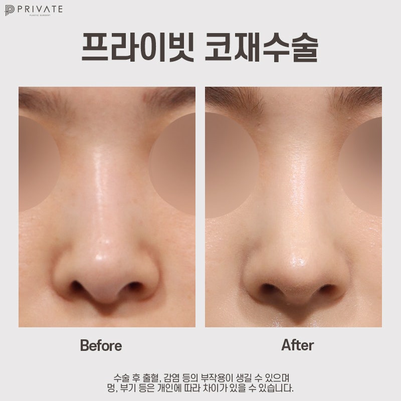 สถานที่ที่ทำศัลยกรรมจมูกแก้ไขได้ดีคือ Private Plastic Surgery Clinic 사진 9