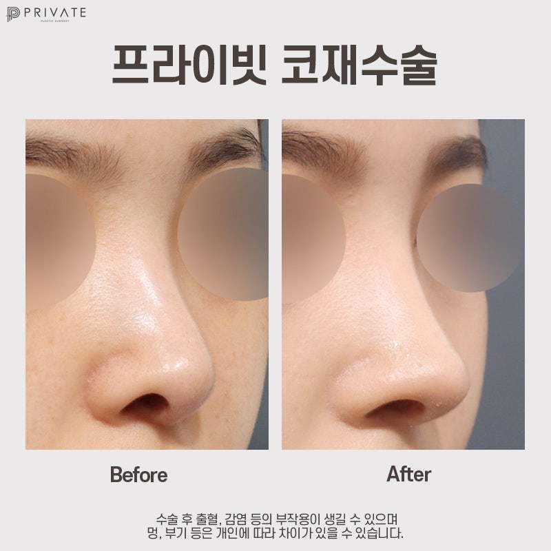 สถานที่ที่ทำศัลยกรรมจมูกแก้ไขได้ดีคือ Private Plastic Surgery Clinic 사진 10