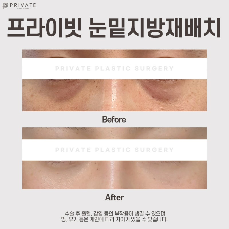 Ulasan Operasi Kantung Mata yang Bagus di Private Plastic Surgery 사진 9