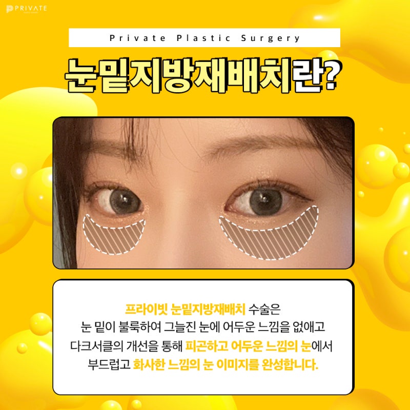 Ulasan Operasi Kantung Mata yang Bagus di Private Plastic Surgery