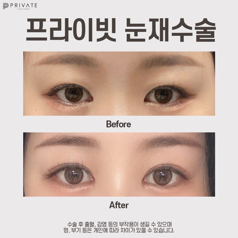 Private Plastic Surgery Clinic Excels in Double Eyelid Revision Surgery 사진 9