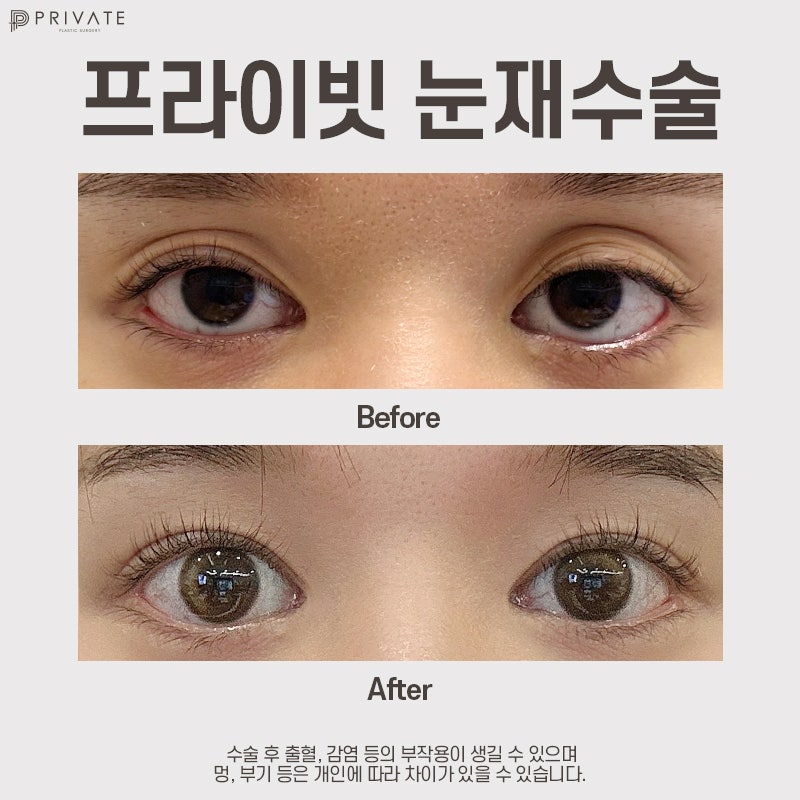 Private Plastic Surgery Clinic Excels in Double Eyelid Revision Surgery 사진 8