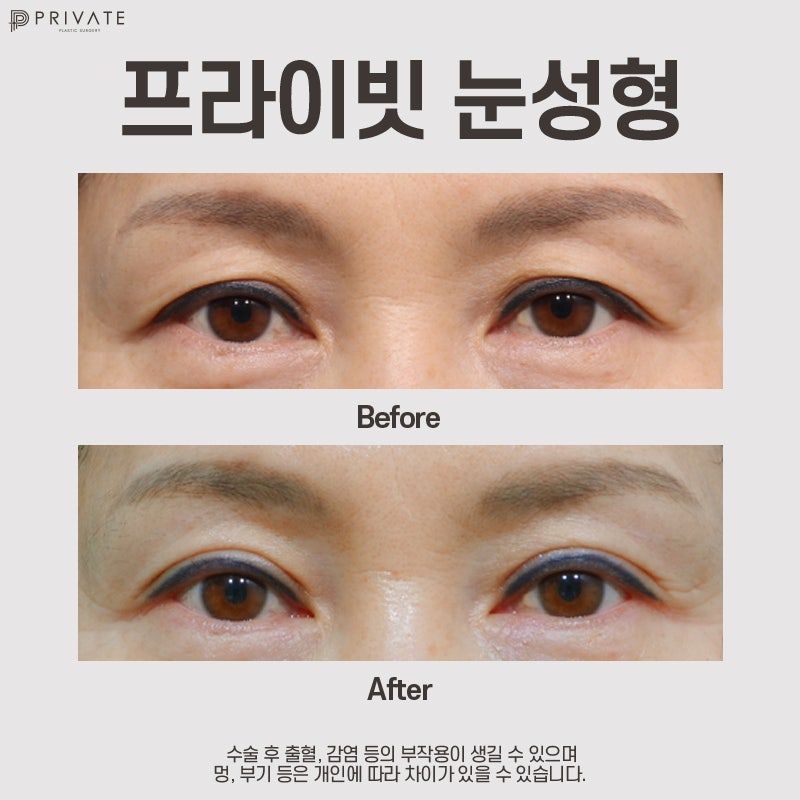 Check Upper Blepharoplasty Reviews at Private Plastic Surgery 사진 7