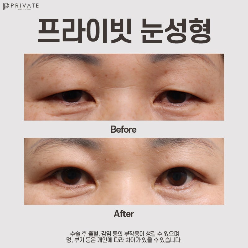 Check Upper Blepharoplasty Reviews at Private Plastic Surgery 사진 8