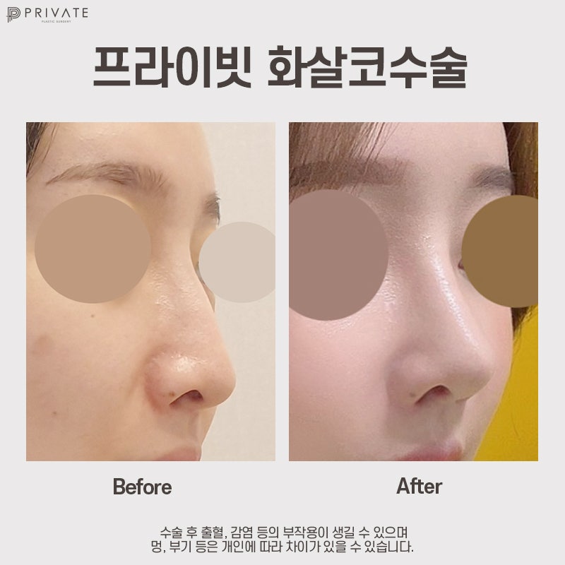 화살코 수술 잘하는곳은 신사 프라이빗성형외과 사진 8