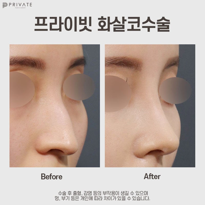 화살코 수술 잘하는곳은 신사 프라이빗성형외과 사진 7