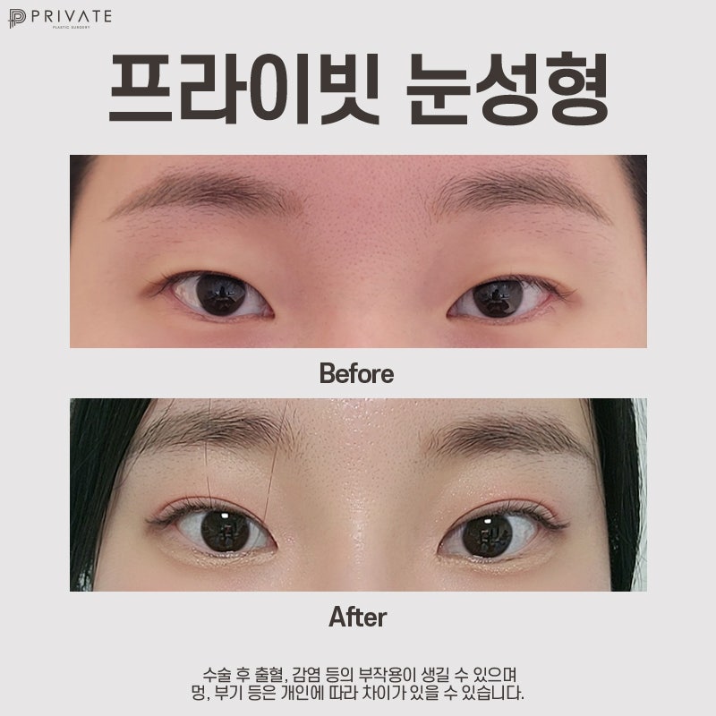 Private Plastic Surgery Clinic: Expert Double Eyelid Surgery 사진 8