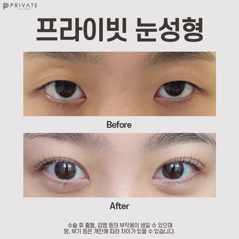 Let's explore natural adhesion double eyelid surgery at Sinsa Private Plastic Surgery Clinic 사진 7