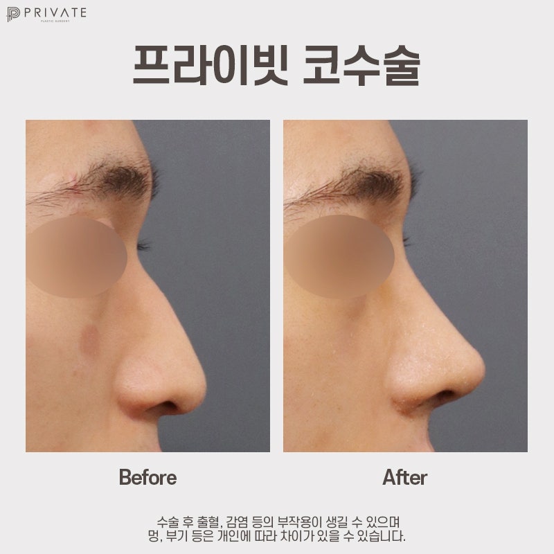 Rumah Sakit Bedah Hidung Pria, Sinsa Private Plastic Surgery 사진 7