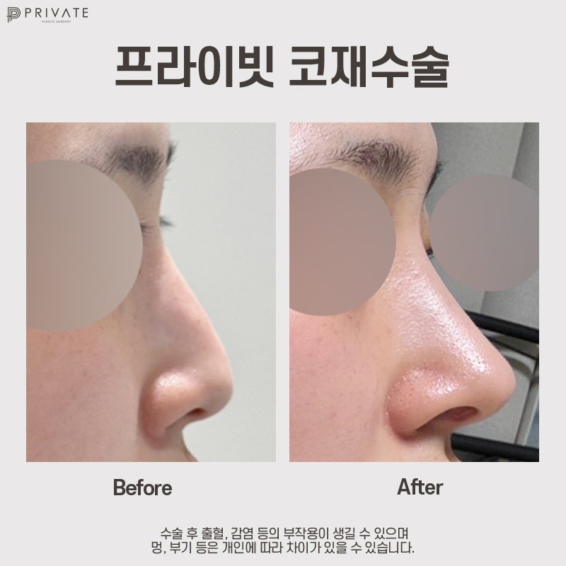 Ulasan Operasi Revisi Hidung di Private Plastic Surgery 사진 7