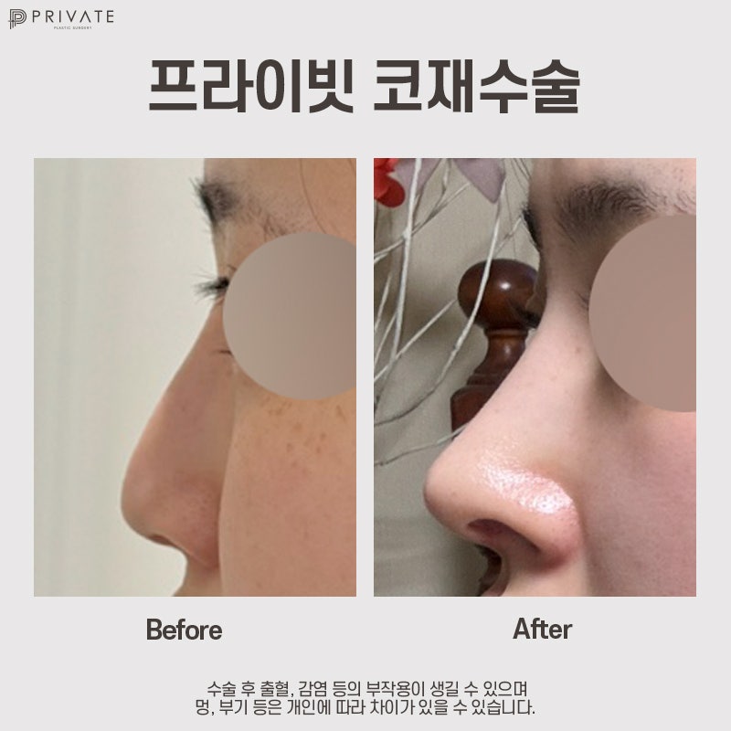 Ulasan Operasi Revisi Hidung di Private Plastic Surgery 사진 8