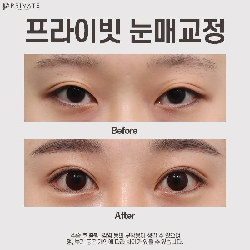 Before and After Ptosis Correction Surgery at Private Plastic Surgery Clinic 사진 8