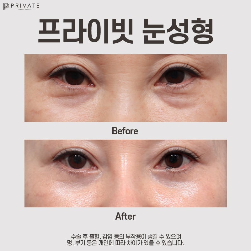 Lower Blepharoplasty at Sinsa Private Plastic Surgery Clinic 사진 8