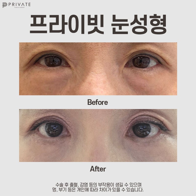 Lower Blepharoplasty at Sinsa Private Plastic Surgery Clinic 사진 7