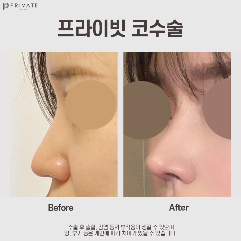 Ulasan Operasi Hidung Panjang yang Bagus di Private Plastic Surgery 사진 9
