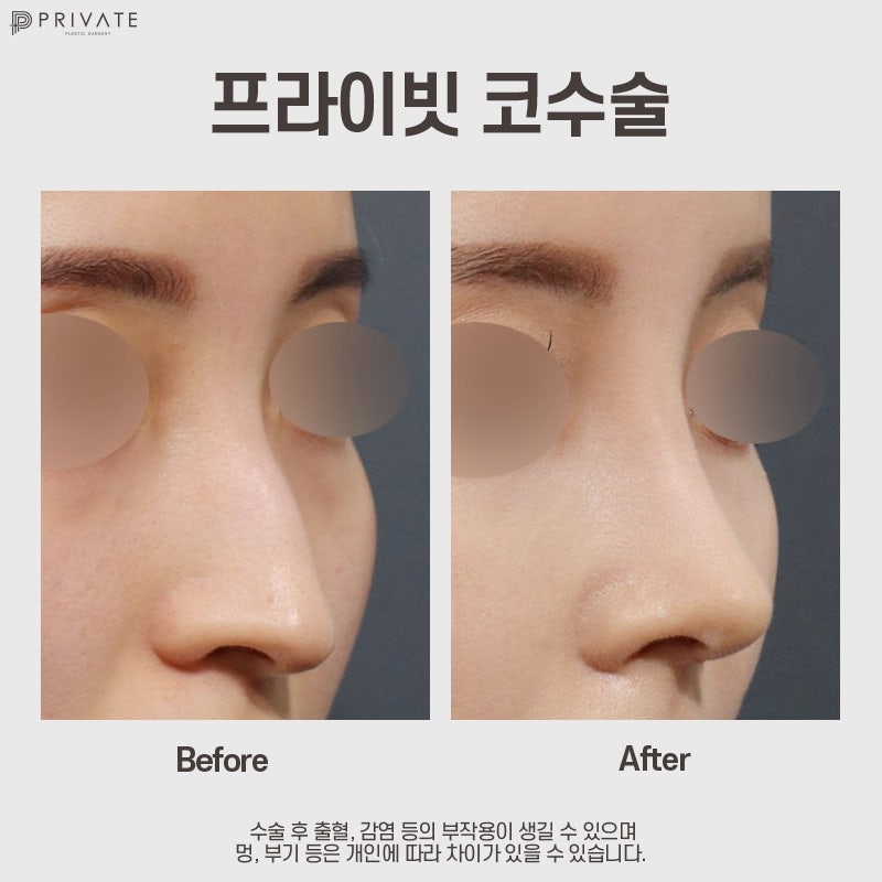 Ulasan Operasi Hidung Panjang yang Bagus di Private Plastic Surgery 사진 8