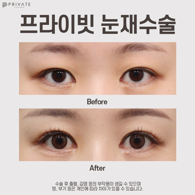 Private Plastic Surgery Clinic: Double Eyelid Revision Surgery Review 사진 8