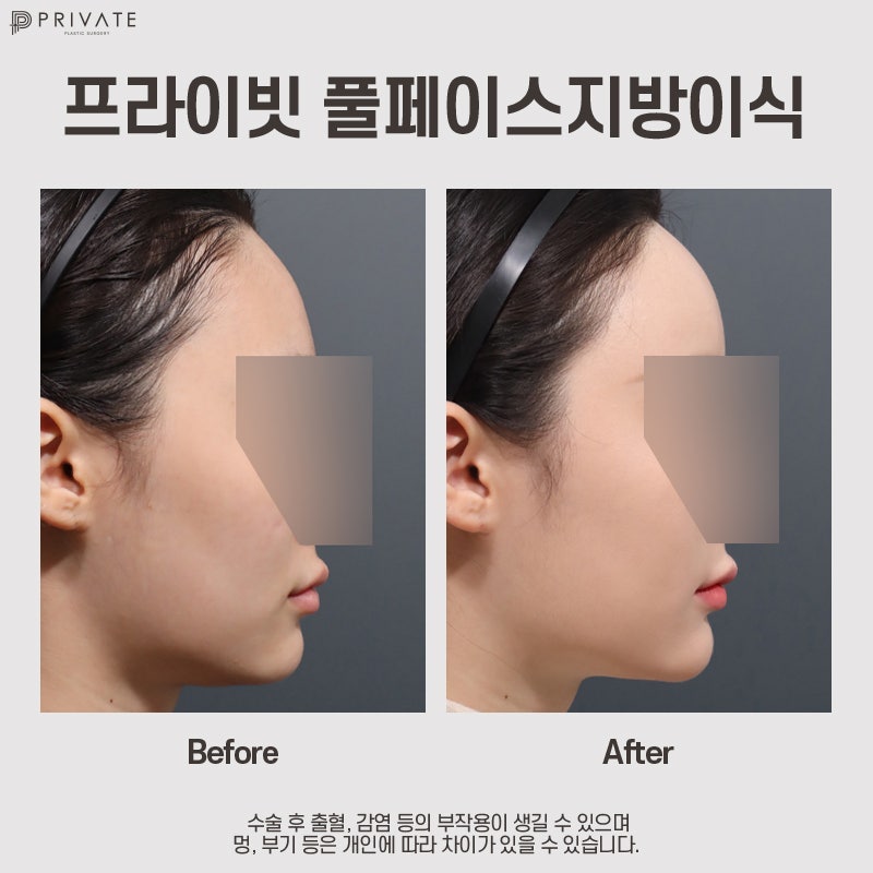 Full Face Fat Grafting: Highly-Rated Private Plastic Surgery Clinic 사진 8