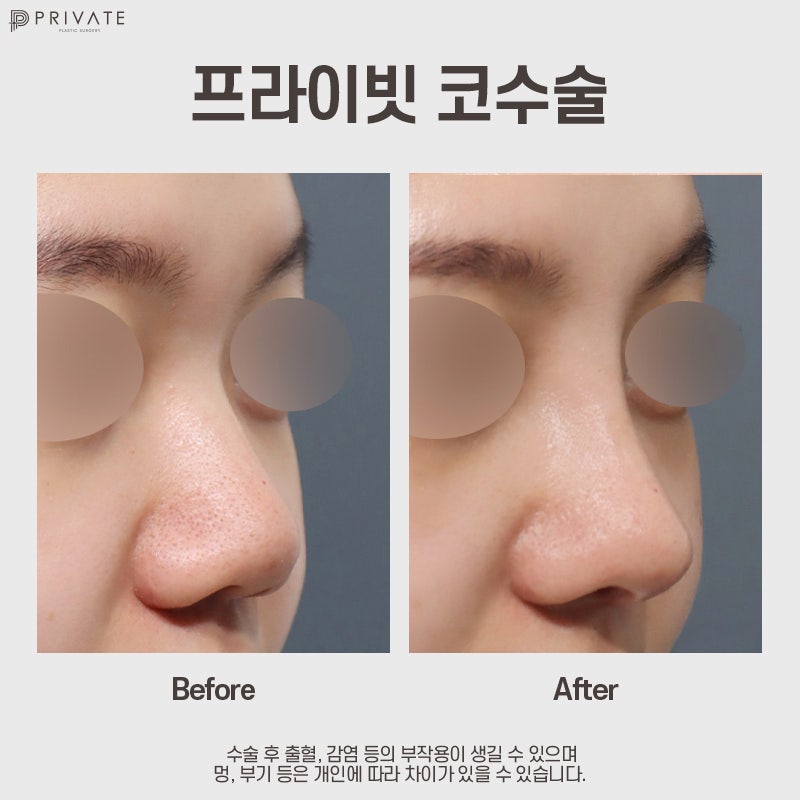 Goddess Nose Surgery at Sinsa Private Plastic Surgery 사진 8