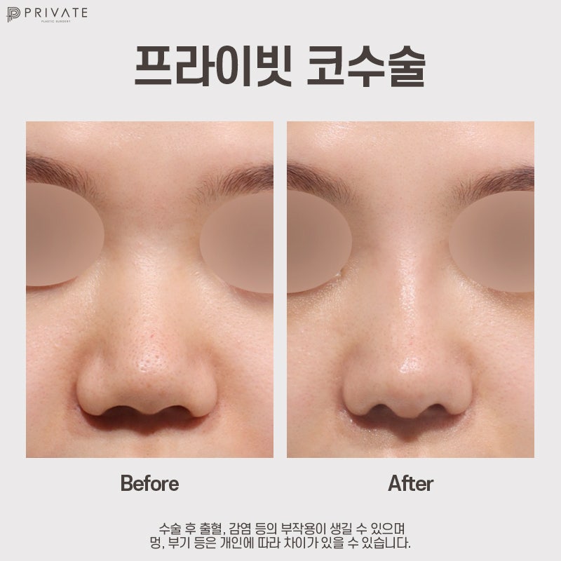Goddess Nose Surgery at Sinsa Private Plastic Surgery 사진 7