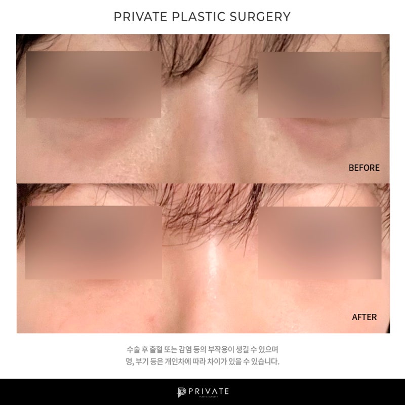 รีวิวการผ่าตัดจัดเรียงไขมันใต้ตาที่ Private Plastic Surgery 사진 8