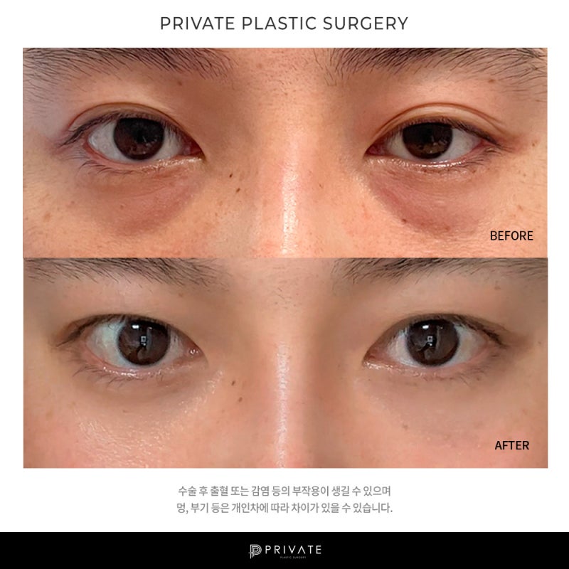 รีวิวการผ่าตัดจัดเรียงไขมันใต้ตาที่ Private Plastic Surgery 사진 7