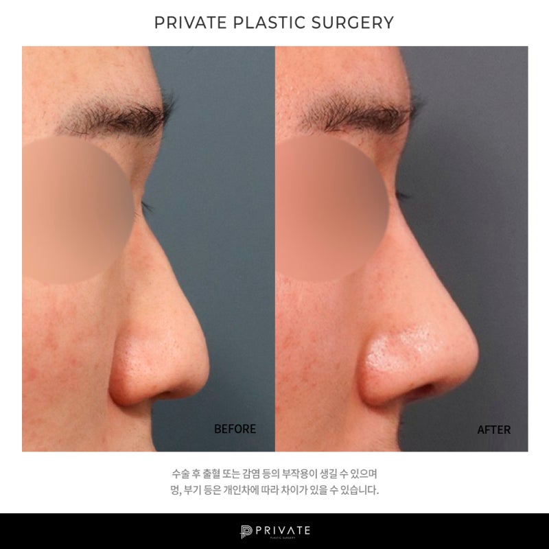 Ulasan Operasi Ujung Hidung Pria di Private Plastic Surgery Clinic 사진 9