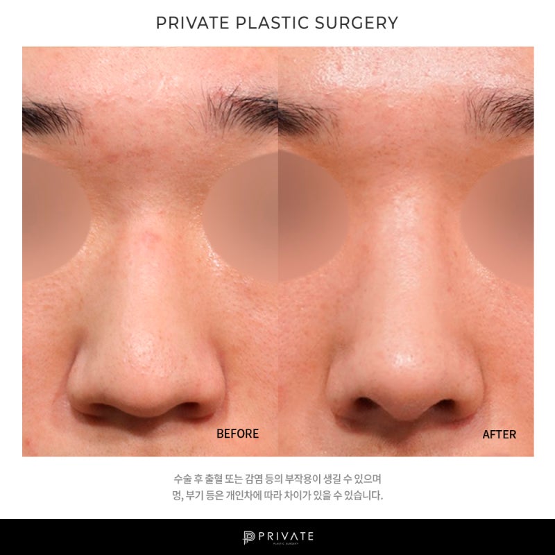 Ulasan Operasi Ujung Hidung Pria di Private Plastic Surgery Clinic 사진 8