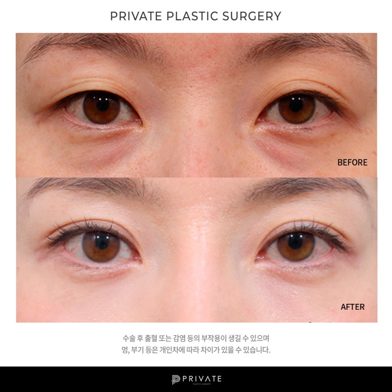 Private Plastic Surgery Clinic with Excellent Ptosis Correction Results 사진 9