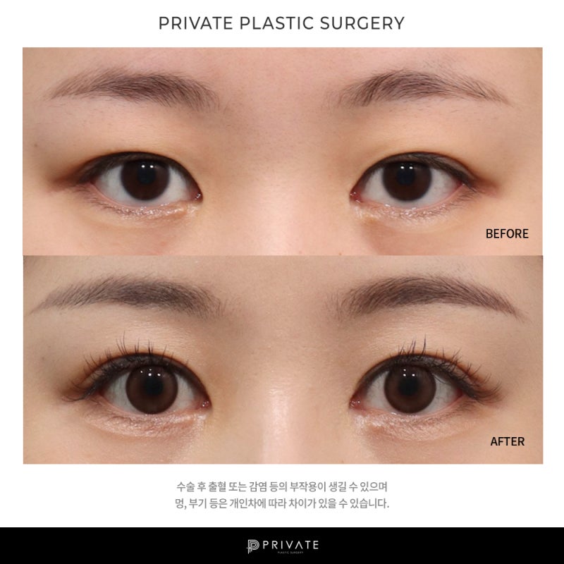 Private Plastic Surgery Clinic with Excellent Ptosis Correction Results 사진 8