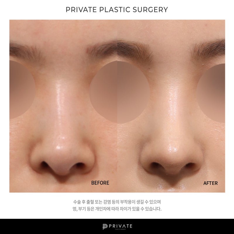 Klinik Bedah Plastik Sinsa Private, Rumah Sakit Terbaik untuk Operasi Revisi Hidung 사진 7