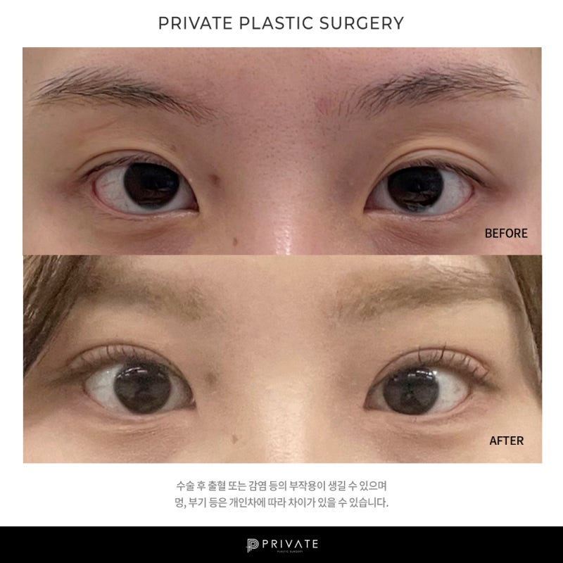 Sinsa Private Plastic Surgery: Expert Eye Revision Surgery 사진 9