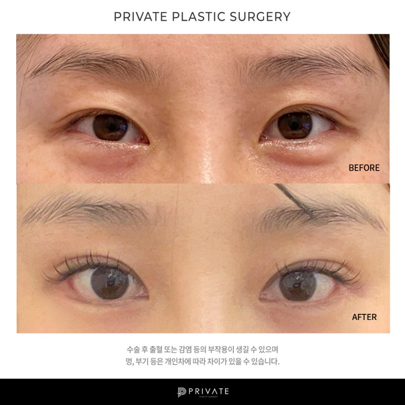 Sinsa Private Plastic Surgery: Expert Eye Revision Surgery 사진 8