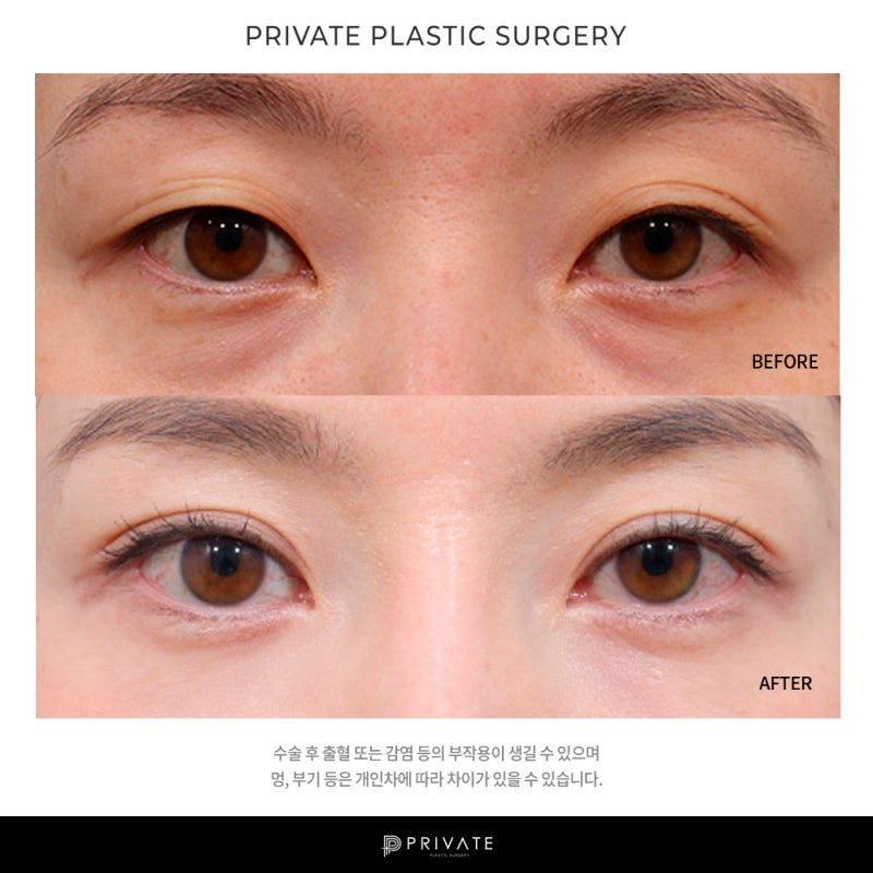 Private Plastic Surgery Clinic ในชินซา ที่มีรีวิวศัลยกรรมตาสองชั้นดีเยี่ยม 사진 8
