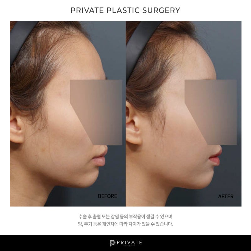 Let's learn about fat grafting surgery at Private Plastic Surgery Clinic 사진 8
