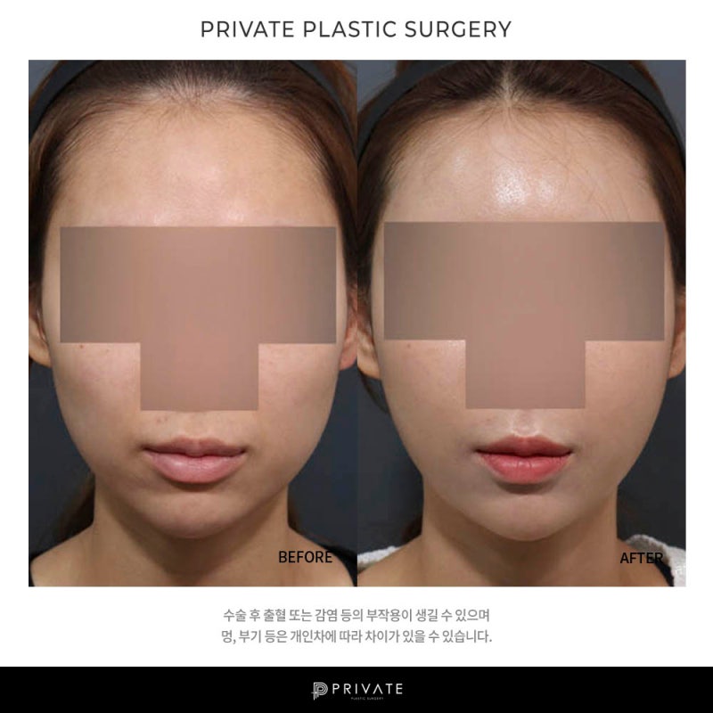 Let's learn about fat grafting surgery at Private Plastic Surgery Clinic 사진 7