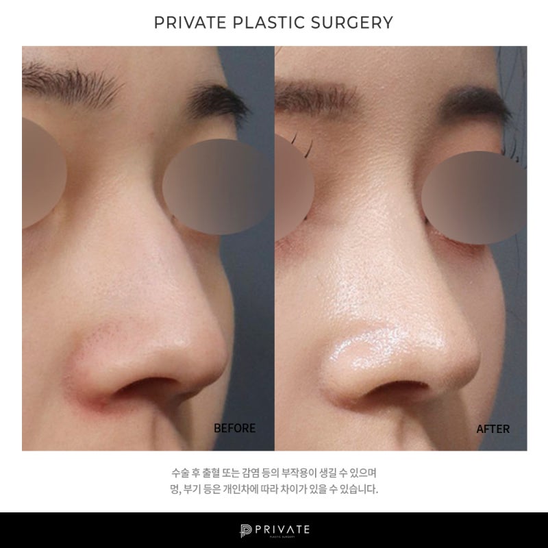 Private Plastic Surgery Clinic: Good Reviews for Nose Surgery 사진 8