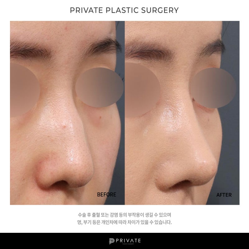 Private Plastic Surgery Clinic: Good Reviews for Nose Surgery 사진 7