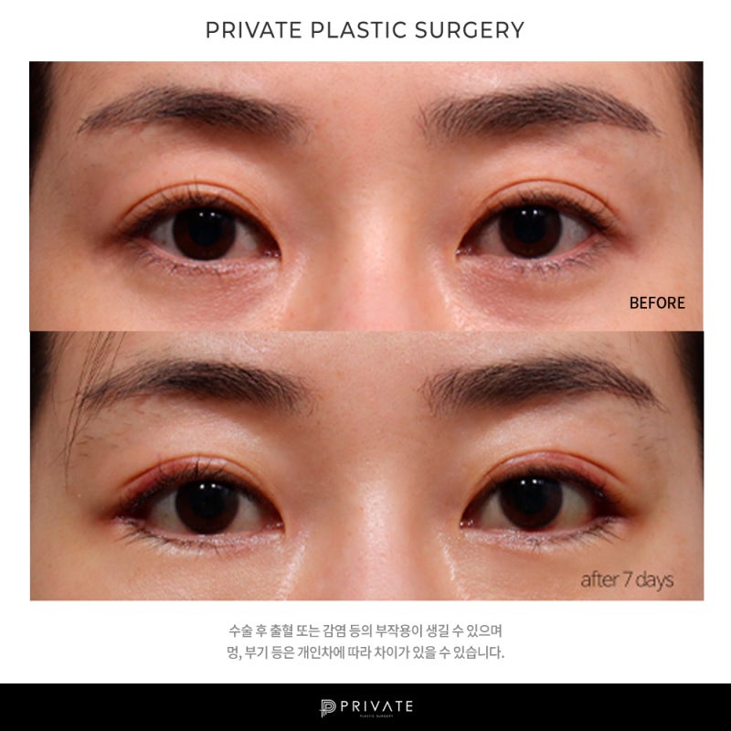 Exploring Private Plastic Surgery's Lateral Canthoplasty 사진 6