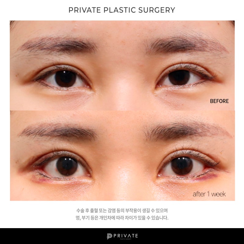 Exploring Private Plastic Surgery's Lateral Canthoplasty 사진 7