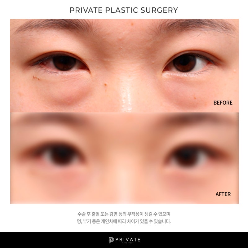 Private Plastic Surgery Clinic Under-Eye Fat Repositioning 사진 7