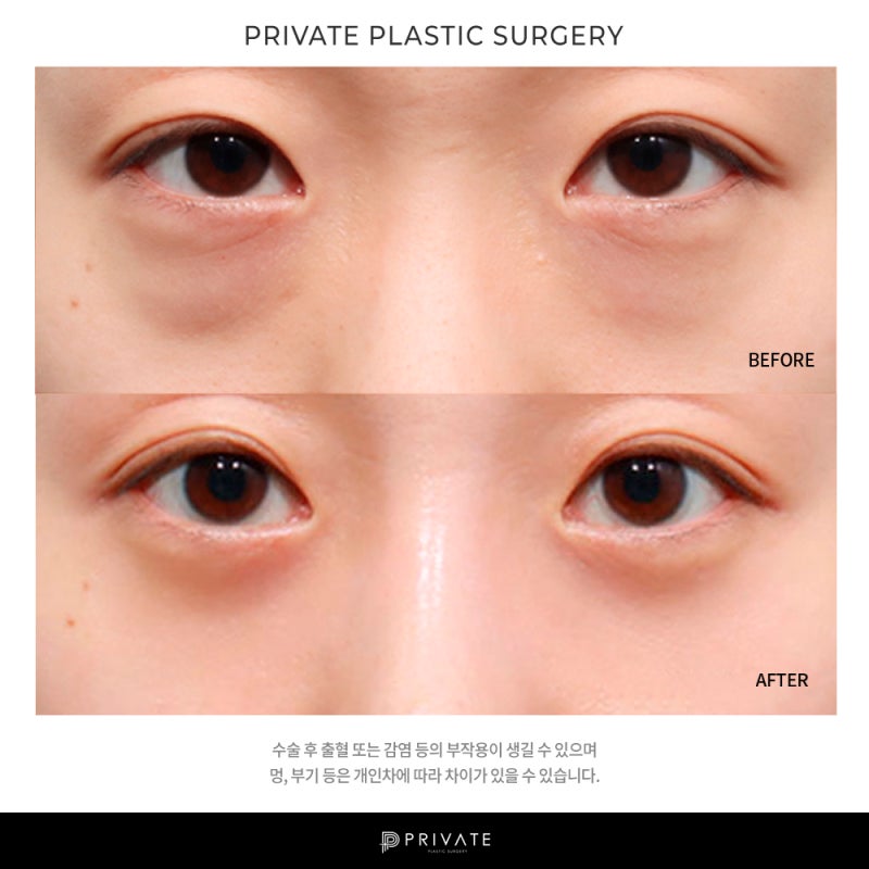 Private Plastic Surgery Clinic Under-Eye Fat Repositioning 사진 10