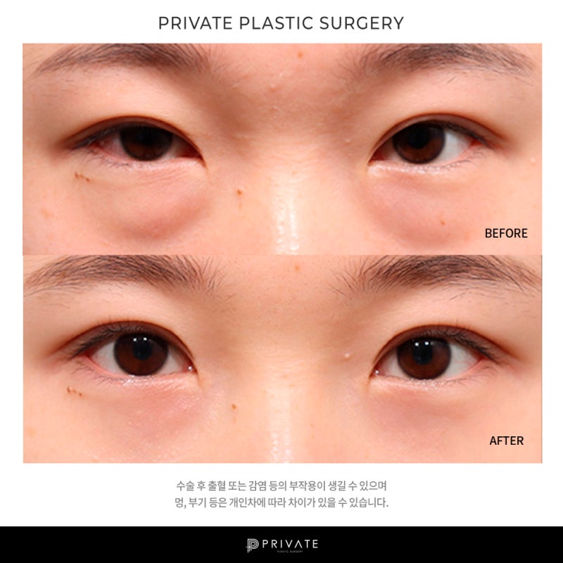 Private Plastic Surgery Clinic Under-Eye Fat Repositioning 사진 8