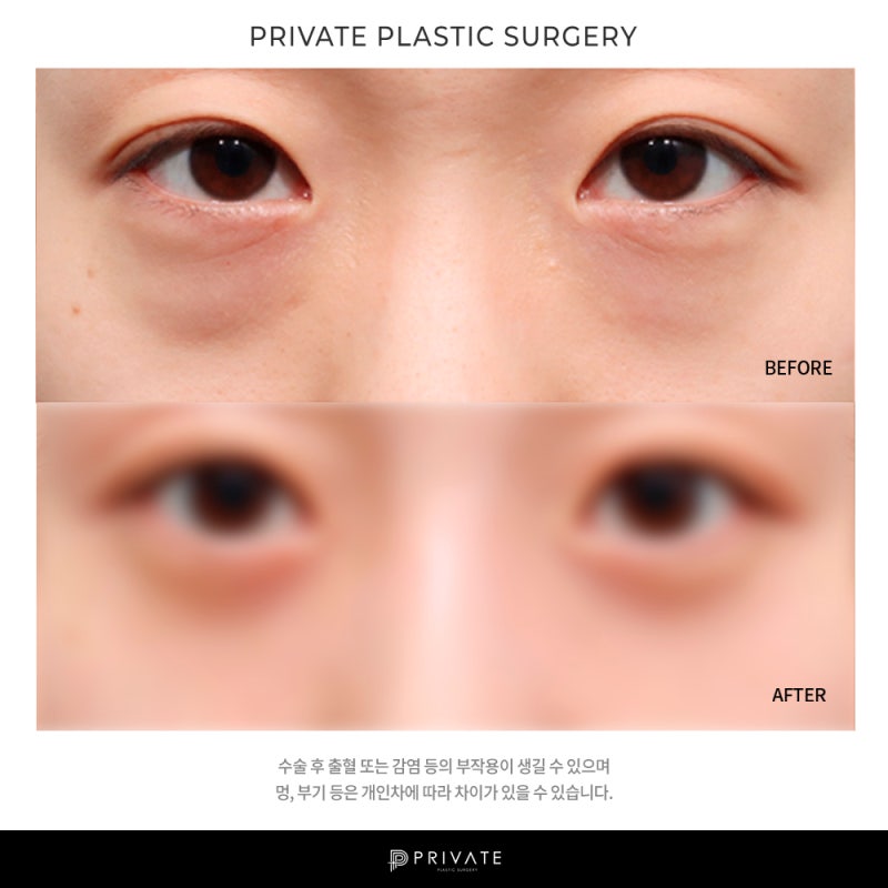 Private Plastic Surgery Clinic Under-Eye Fat Repositioning 사진 9