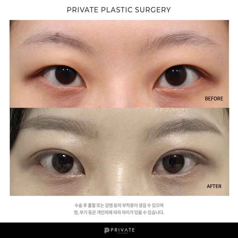 Let's explore double eyelid surgery at Private Plastic Surgery 사진 10